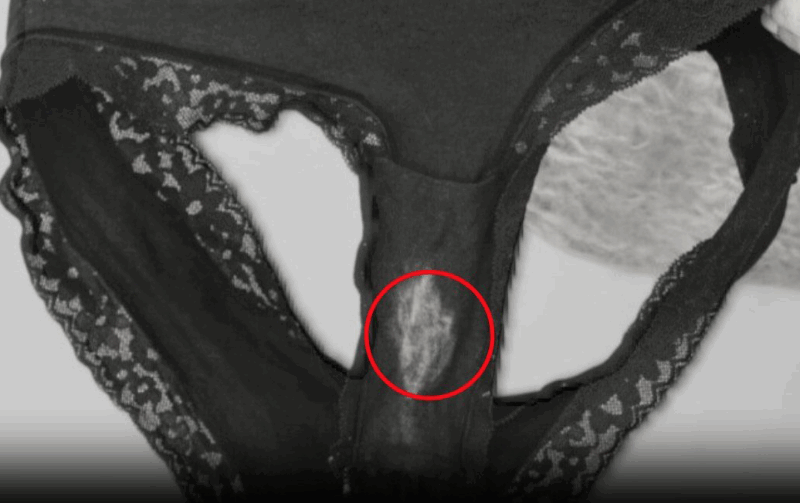 What Lightened Patches on Your Underwear Indicate