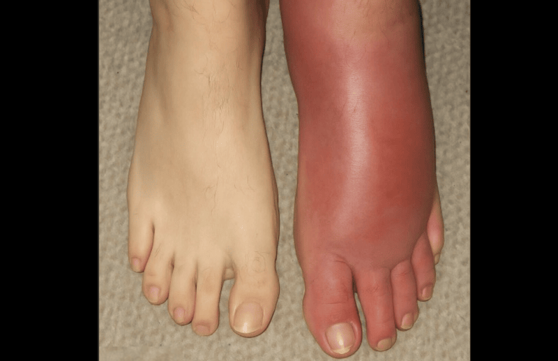 Unexpected Redness and Swelling in Your Leg: Possible Causes