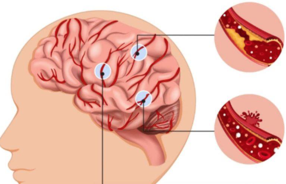 15 Essential Foods Everyone Should Eat to Help Prevent Stroke