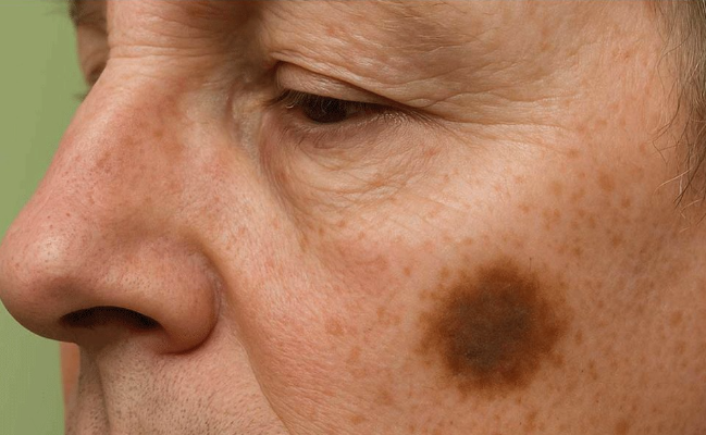 Discover a Simple 2-Ingredient Solution to Fade Brown Spots on Your Skin